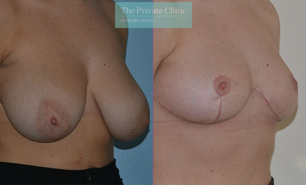Breast Reduction - 082AR-R - Angle