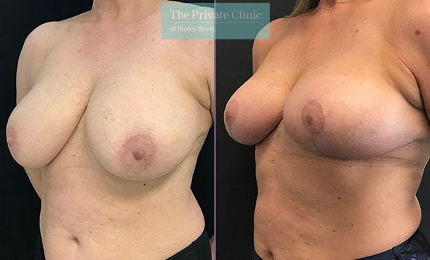 Breast Reduction - 084AR-R - Angle