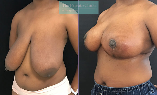 Breast Reduction - 085AR-R - Angle