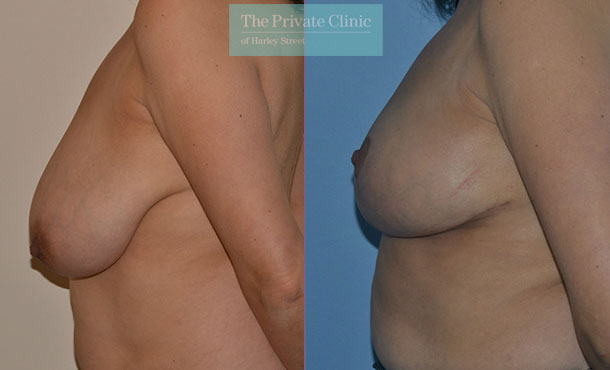 Breast Reduction - 072AR-R - Side