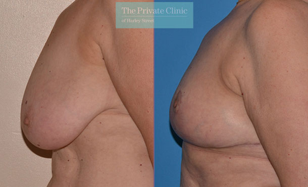 Breast Reduction - 075AR-R - Side