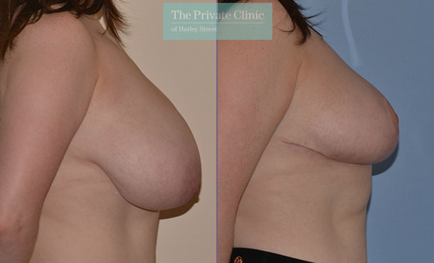 Breast Reduction - 077AR-R - Side