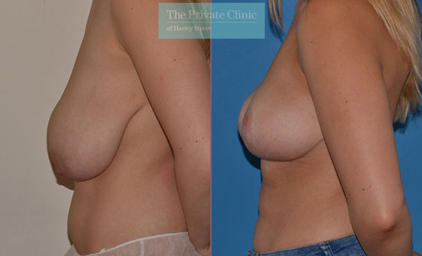 Breast Reduction - 080AR-R - Side