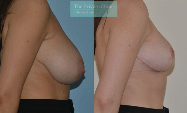 Breast Reduction - 082AR-R - Side