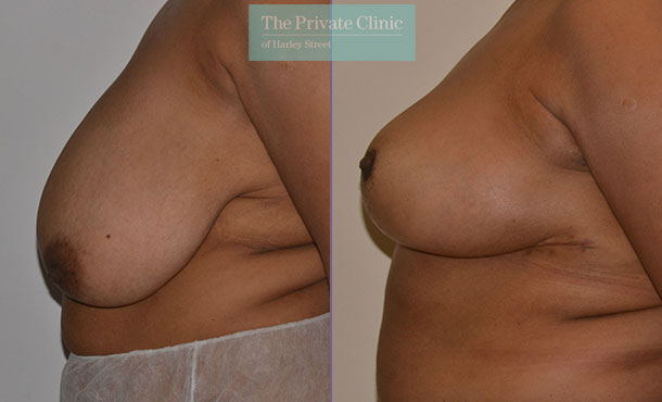 Breast Reduction - 083AR-R - Side