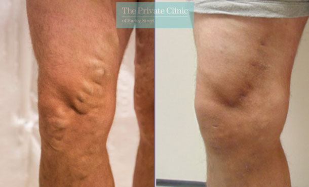 varicose vein on legs before after treatment results