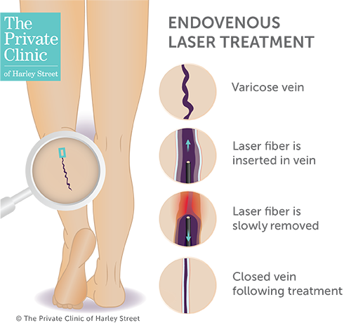 EVLA treatment for Varicose veins