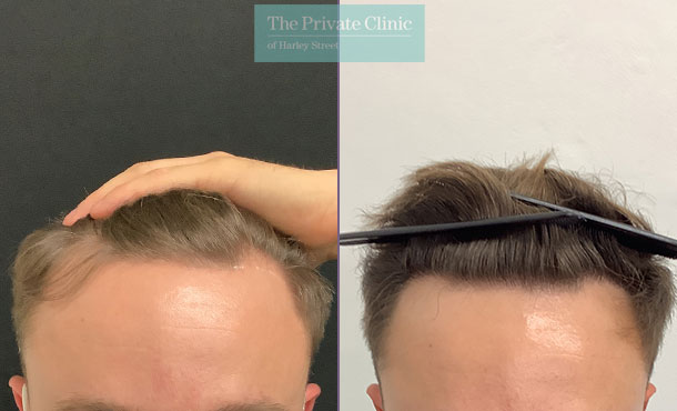 FUE Hair Transplant - 023FR - Front