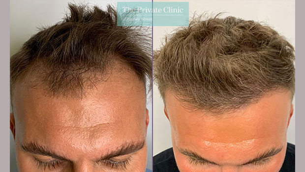 hair transplant diary recovery aftercare alex patient review story