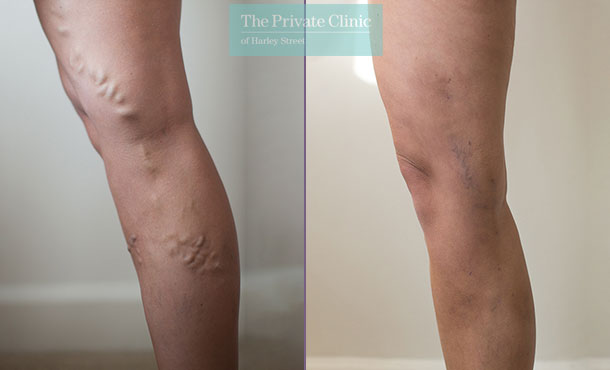 varicose vein treatment before after results