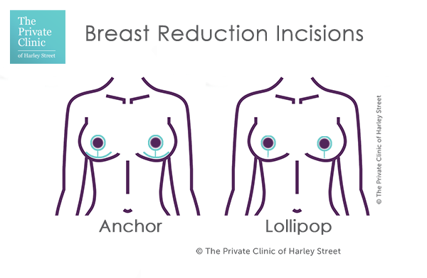breast reduction scars
