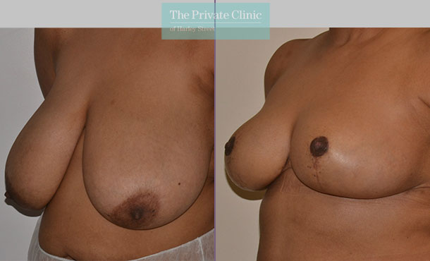 breast reduction and uplift surgery before after photos
