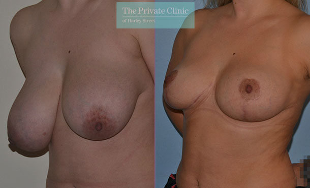breast reduction surgery results before after photos
