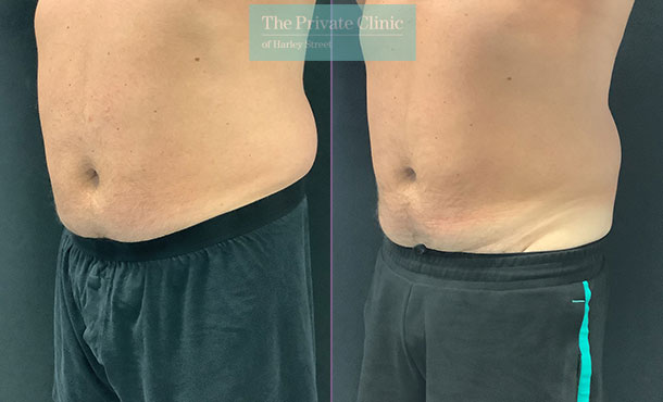 Before and after photos of CoolSculpting