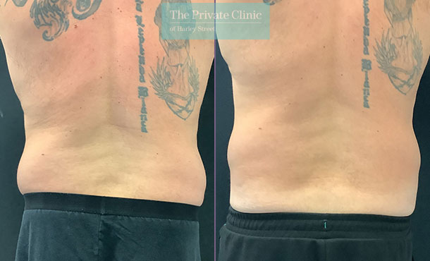 CoolSculpting - 002EA - back