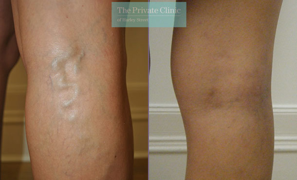 Varicose Vein removal leg before and after photo