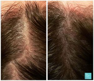 scalp micropigmentation for women before and after results