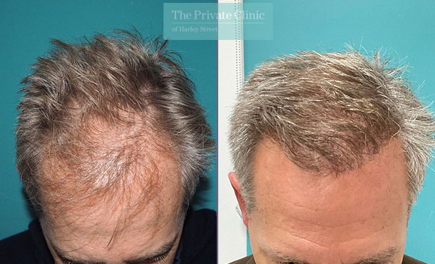 FUE Hair Transplant - 040MM-front