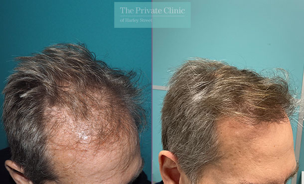 FUE Hair Transplant - 040MM-side