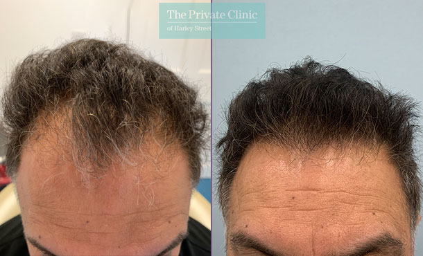 FUE Hair Transplant - 025FR