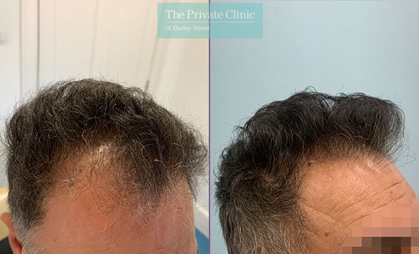 Before and after photos of FUE Hair Transplant Procedure