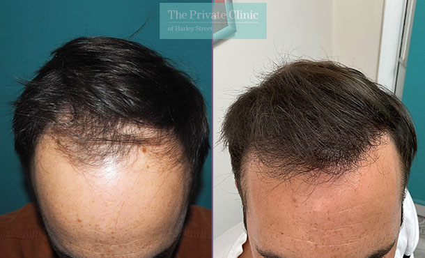 FUE Hair Transplant - 039MM - Front