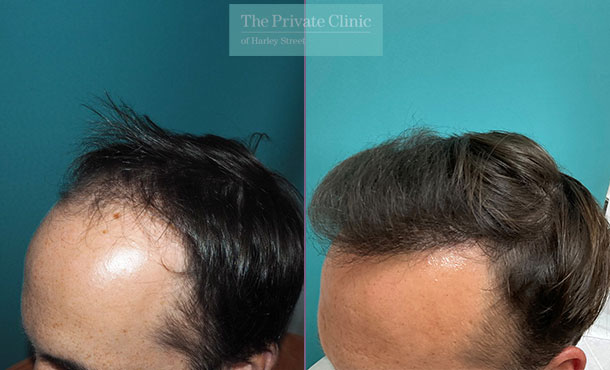 FUE Hair Transplant - 039MM - Side