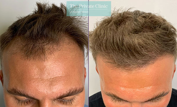 FUE Hair Transplant - 024FR-front