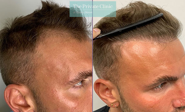 FUE Hair Transplant - 024FR-side