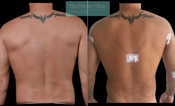 Hi-Def Vaser Liposuction - 003L-MM-back