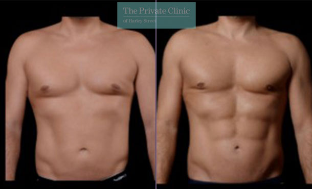 Before and after photos of Vaser Hi Def Lipo Procedure