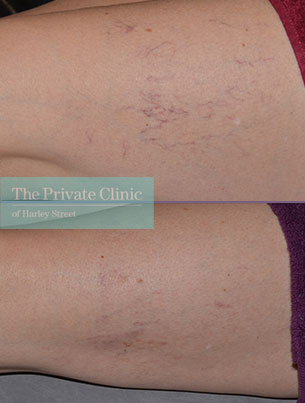 spider veins legs removal before after photo