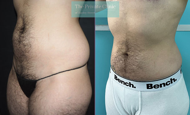 Before and after photos of Micro Lipo Procedure