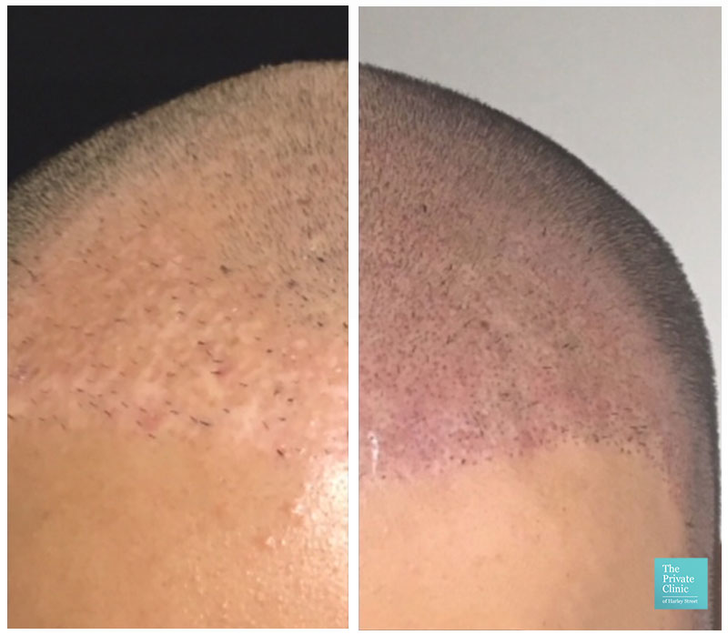scalp micropigmentation hairline before and after photo