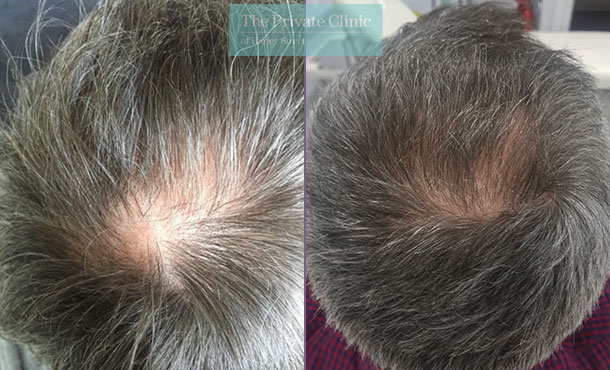 Scalp micropigmentation with grey hair before and after results