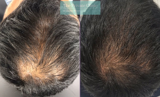 Best clinics for scalp micropigmentation in Lambeth, London