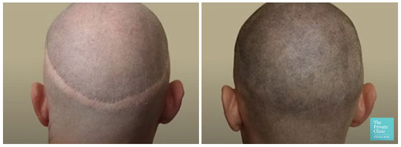 Scalp micropigmentation with hair transplant scars before after photos
