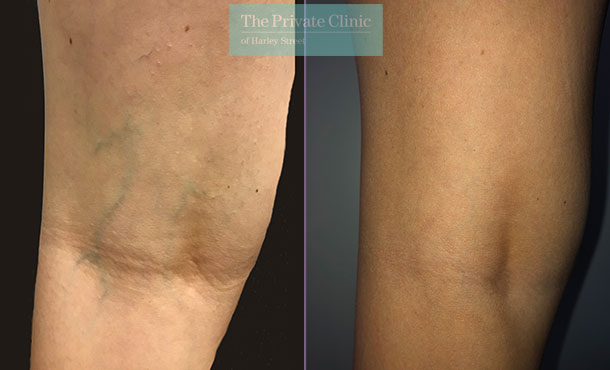 thread vein removal legs before and after photos