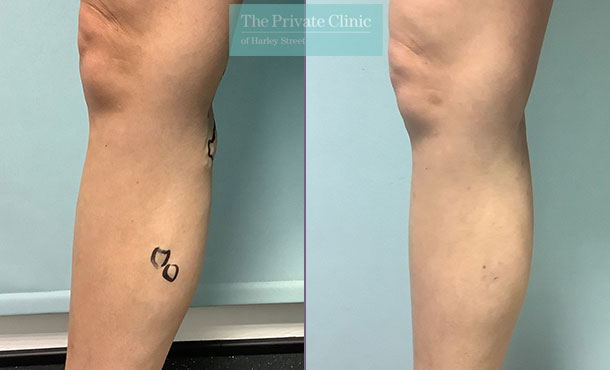 spider veins on legs before after photo