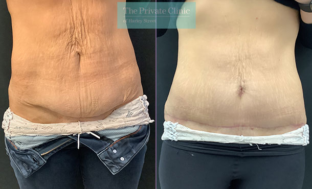 Abdominoplasty - 004HA - front