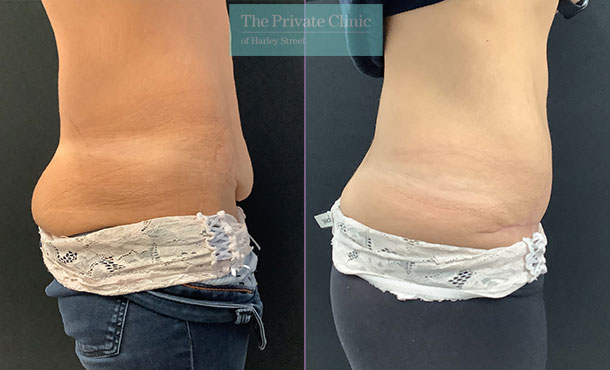 before and after photo of tummy tuck