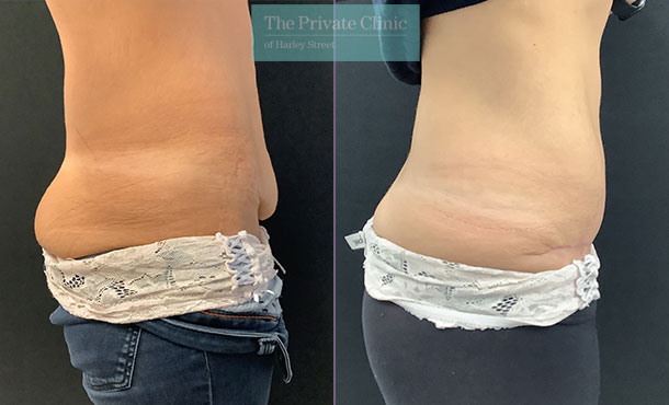 Tummy Tuck - Before & After Images - The Private Clinic of Harley Street  London