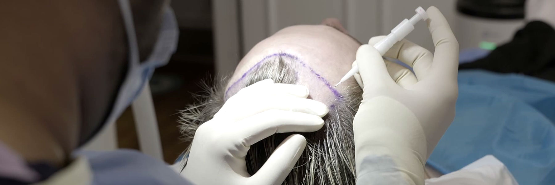 Is hair transplant safe and permanent, what is the success rate of hair  transplant