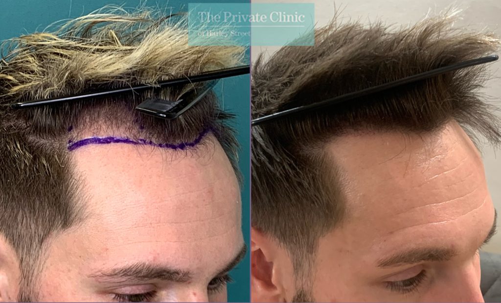 FUE Hair Transplant frontal area Before and after photos