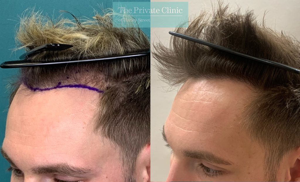 FUE Hair Transplant front hairline Before and after photos