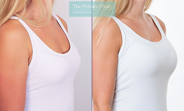 breast enlargement before and after photos