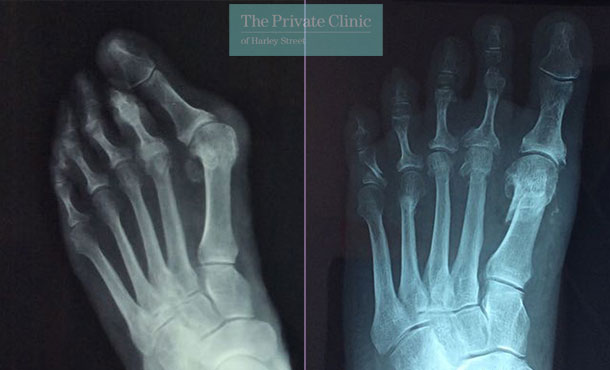 X-ray before and after images of Bunion correction showing no screws
