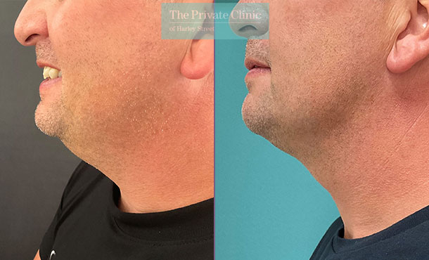 chin liposuction male before and after photos