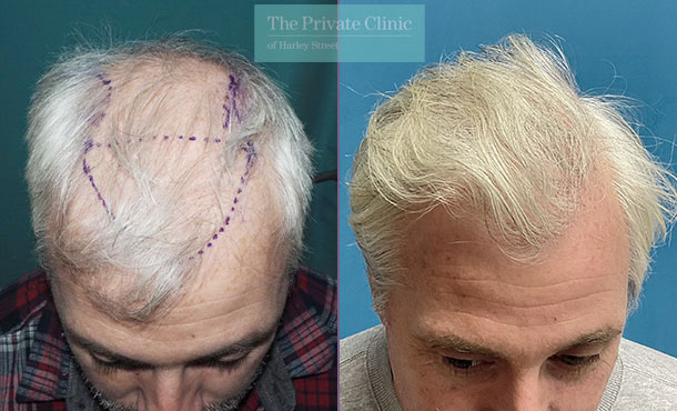 FUE Hair Transplant - 042MM - front