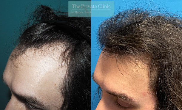 FUE Hair Transplant - 041MM - SIDE